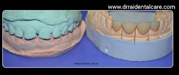 Emax Laminate Veneers