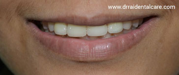 Smile post bonding of veneers