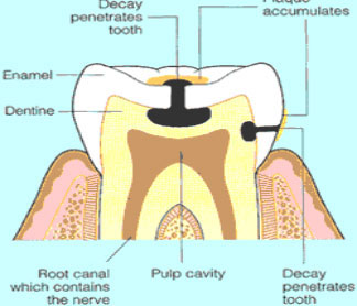 Dental Caries Cavities
